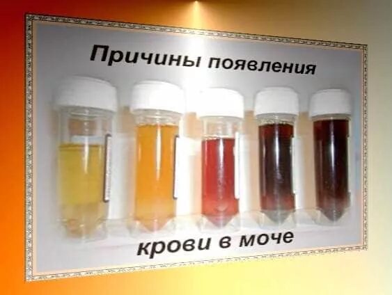 Почему краснеет моча. Кровь в моче. моча с кровью у женщин причины. моча с примесью крови. моча с кровью у мужчин причины.