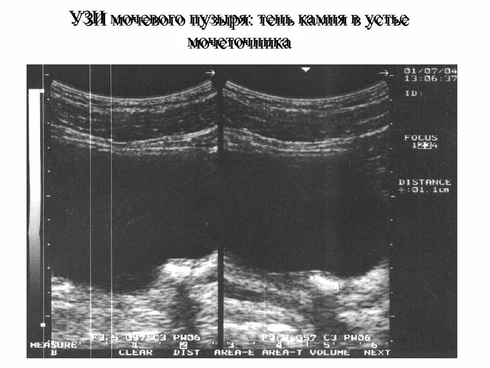 Камень устья мочеточника на узи. Камень в устье. Камень устья мочеточника на узи. Камень в устье мочеточника на узи. Камень в устье мочеточника на узи.