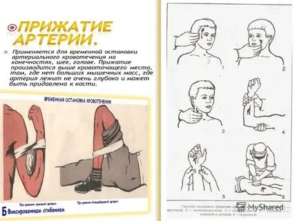 Способы остановки кровотечения обж