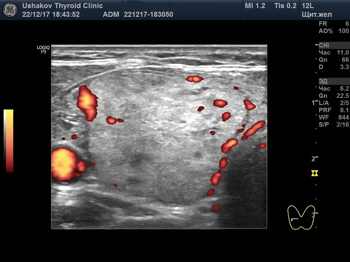 Узловые образования обеих долей щитовидной железы. Щитовидная железа УЗИ ti-rads. Кровоток щитовидной железы УЗИ. Узловая форма щитовидной железы. Узловые образования щитовидной железы на УЗИ.