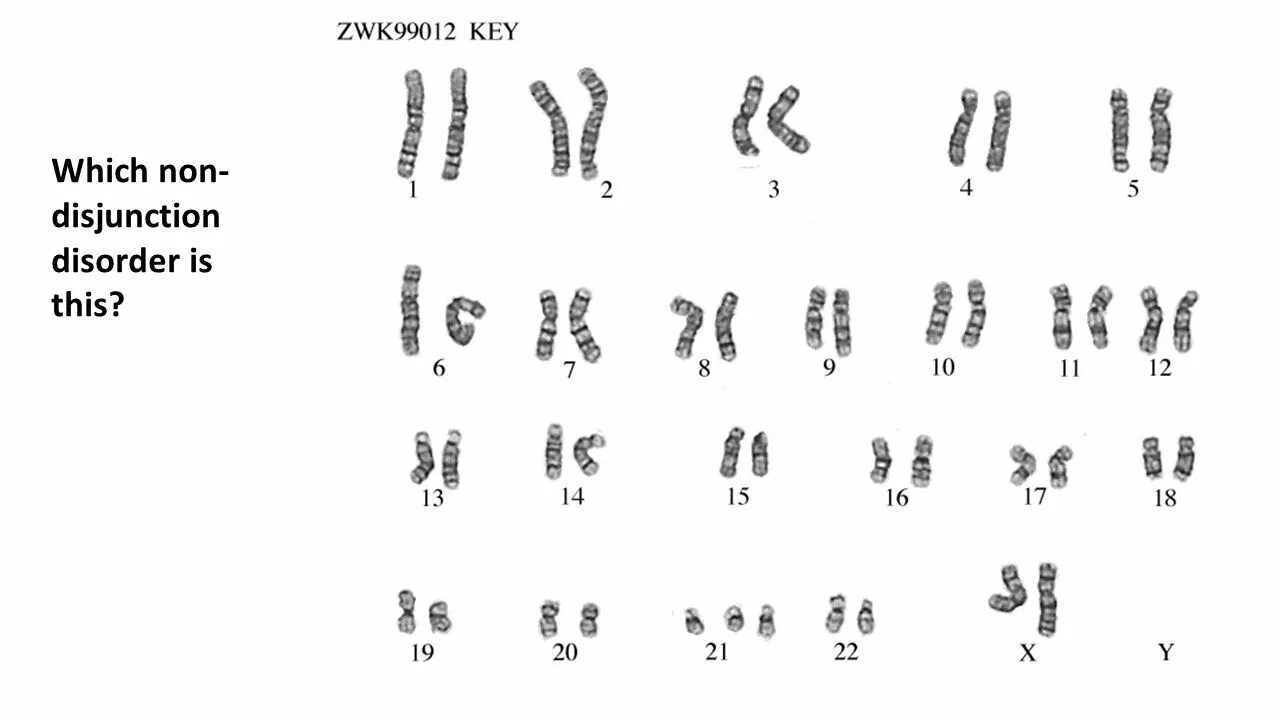 Хромосомы краба. Синдром Дауна трисомия 21 хромосомы. Трисомия по 21 хромосоме. Синдром Дауна кариотип.