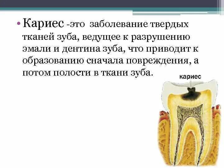 Поражение кариесом определяется индексом