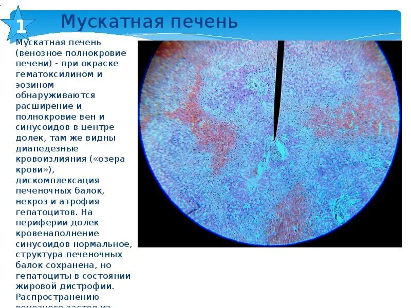 Печень микропрепарат описание. Мускатная печень патанатомия макропрепарат. Мускатная печень (окраска гематоксилином-эозином).. Мускатная печень гематоксилин эозин. Мускатная печень гистология.