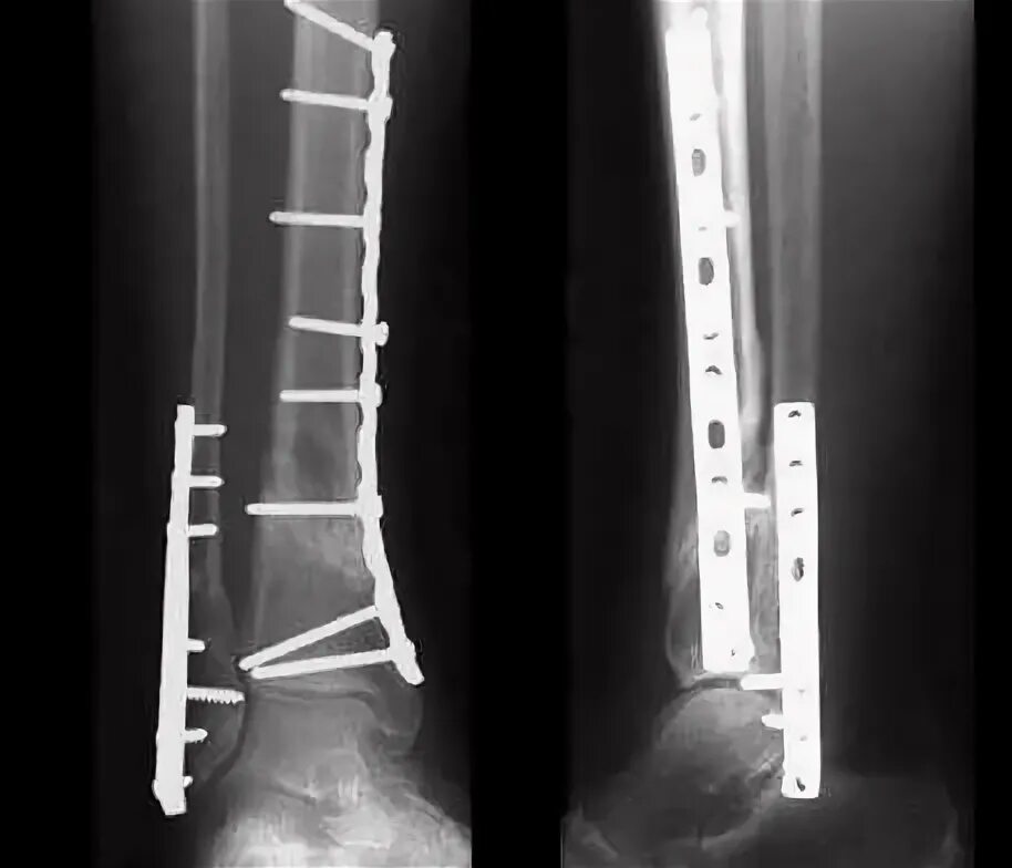Перелом со смещением нужна операция. Накостный остеосинтез голени рентген. Остеосинтез костей голени операция. Остеосинтез костей голени рентген. Аппарат Илизарова экстрамедуллярный остеосинтез.