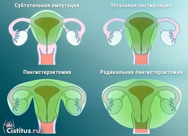 Гистерэктомия что это такое простыми. Матка экстирпация матки. Экстирпация и ампутация матки разница.