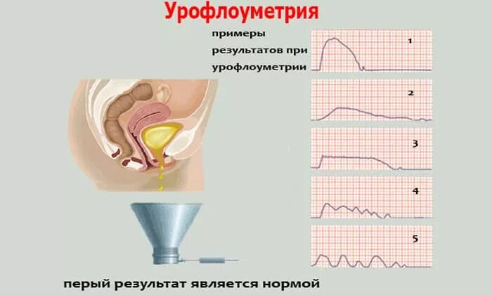 Измерение скорости потока мочи урофлоуметрия. Стриктура уретры урофлоуметрия. Урофлоуметрия показатели нормы. Норма мочеиспускания при урофлоуметрии.