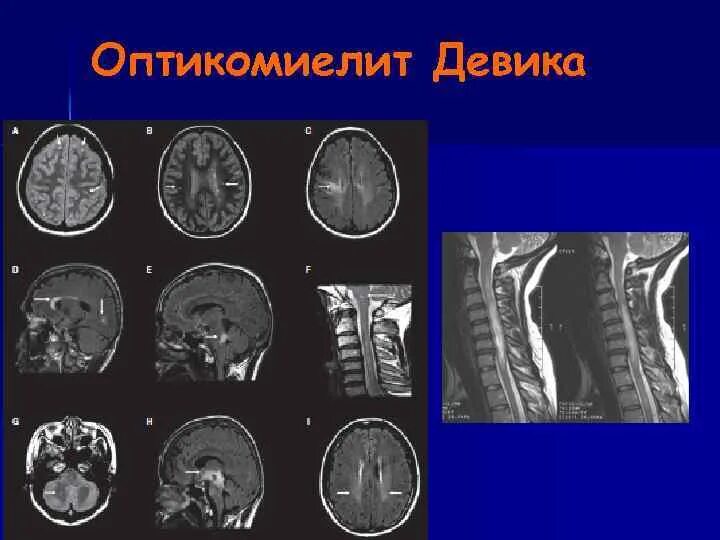 Оптикомиелит девика мрт. Оптикомиелит девика мрт. Оптикомиелит мрт. Рассеянный склероз оптикомиелит девика. Болезнь девика.