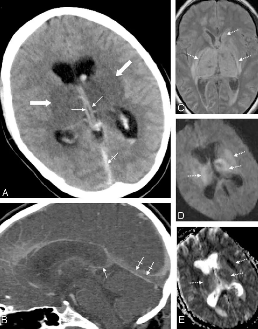 Тромбоз венозного синуса на кт. Тромбоз венозного синуса головного мозга кт. Тромбоз на кт