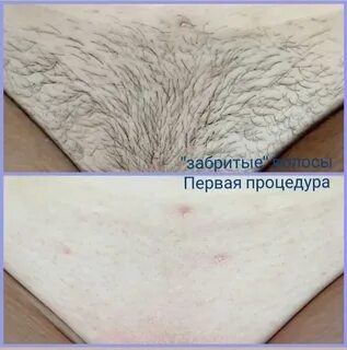 Депиляция воском воронеж