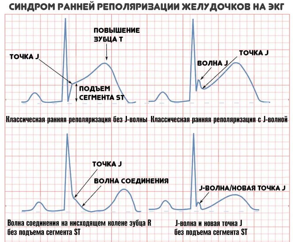 Экг метаболические изменения что это значит. Синдром ранней реполяризации желудочков. Синдром ранней реполяризации на ЭКГ. Синдром (феномен) ранней реполяризации желудочков. Ранняя реполяризация желудочков сердца на ЭКГ.