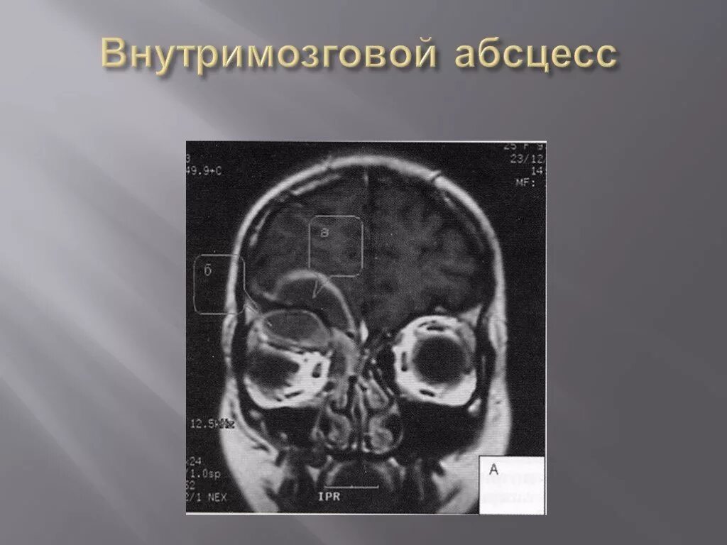 Гнойный мозг. Экстрадуральный абсцесс кт. Субдуральный абсцесс кт. Субдуральный абсцесс мрт.