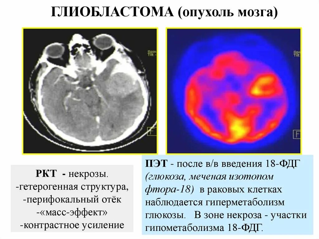 Перифокальный отек мозга на кт. ПЭТ-кт глиобластома. ПЭТ кт опухоли головного мозга. Мультиформная глиобластома. Опухоль глиобластома