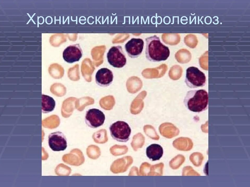 Лимфолейкоз у взрослых. Клетки Боткина Гумпрехта это. Хронический лимфоцитарный лейкоз (ХЛЛ). В-клеточный хронический лимфолейкоз.