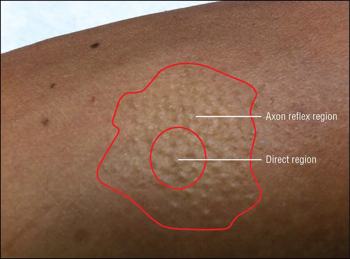 Аксон рефлекс. Механизм Аксон рефлекса. Аксон рефлекс патофизиология. Quantitative sudomotor Axon Reflex.