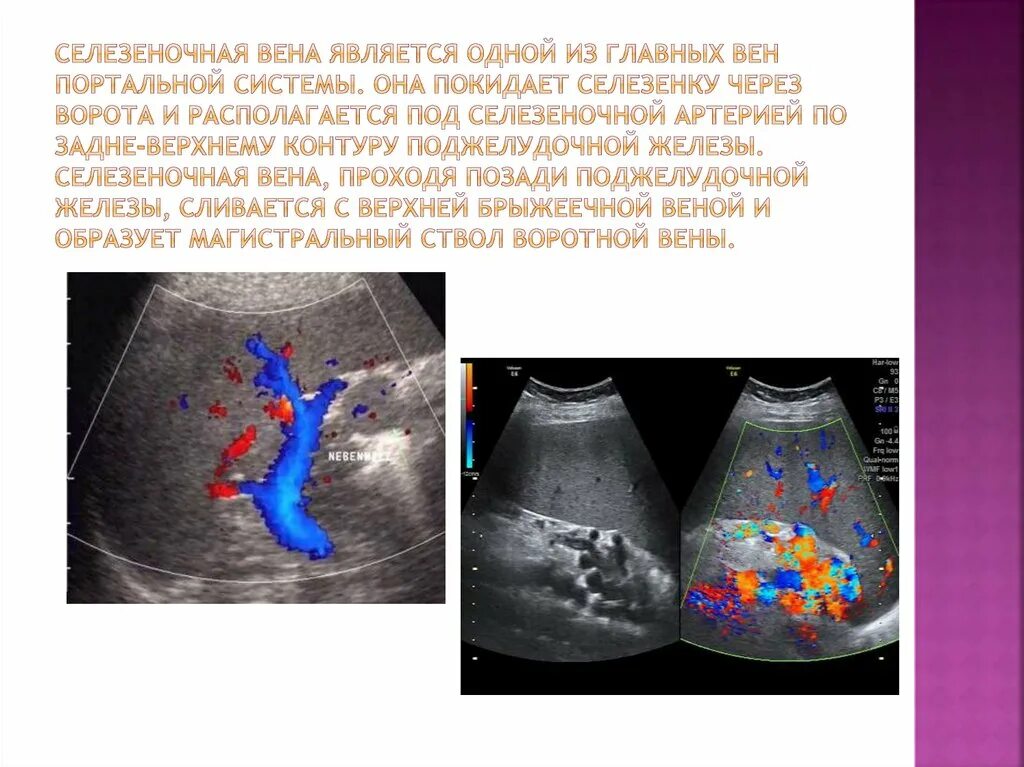 Диаметр селезеночной вены. Норма селезеночной вены на узи. Узи признаки гепатомегалии. Воротная вена селезенки узи. Селезеночная вена в норме.