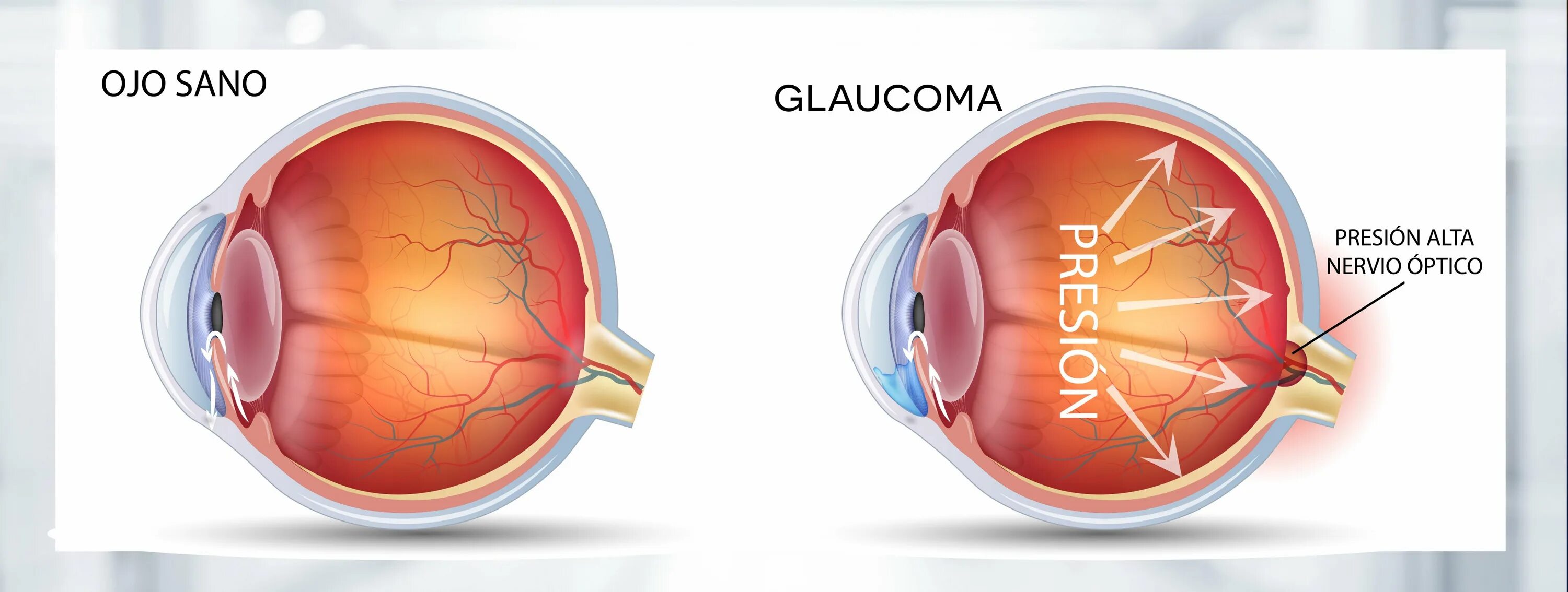 Причины глаукомы глаза. Терминальная глаукома.