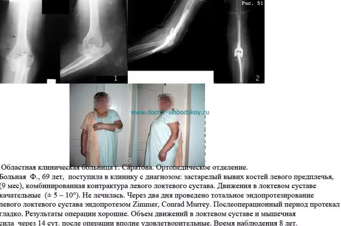 Контрактура сустава после перелома. Контрактура локтевого сустава рентген описание. Посттравматическая контрактура локтевого сустава. Контрактура локтевого сустава врожденная. Эндопротезирование локтевого сустава артропластика.