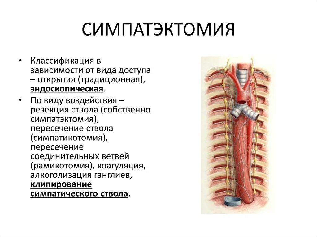 Симпатэктомия цена. Эндоскопическая торакальная симпатэктомия. Торакальная симпатэктомия ход операции. Поясничная симпатэктомия. Торакоскопическая грудная симпатэктомия.