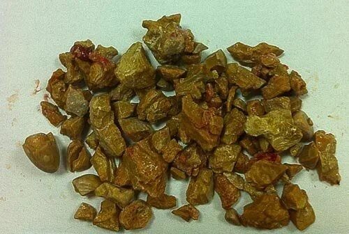 плотность камней в почках таблица. карбонатные камни в почках. фосфатные оксалатные уратные камни. классификация камней при мочекаменной болезни. исследование почечных камней.