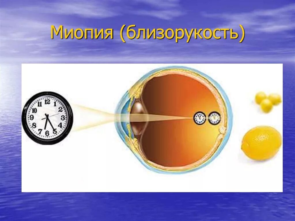 Дефекты зрения ответы. Близорукость дальнозоркость астигматизм. Дефекты зрения близорукость. Дефекты зрения астигматизм. Сложный миопический астигматизм.