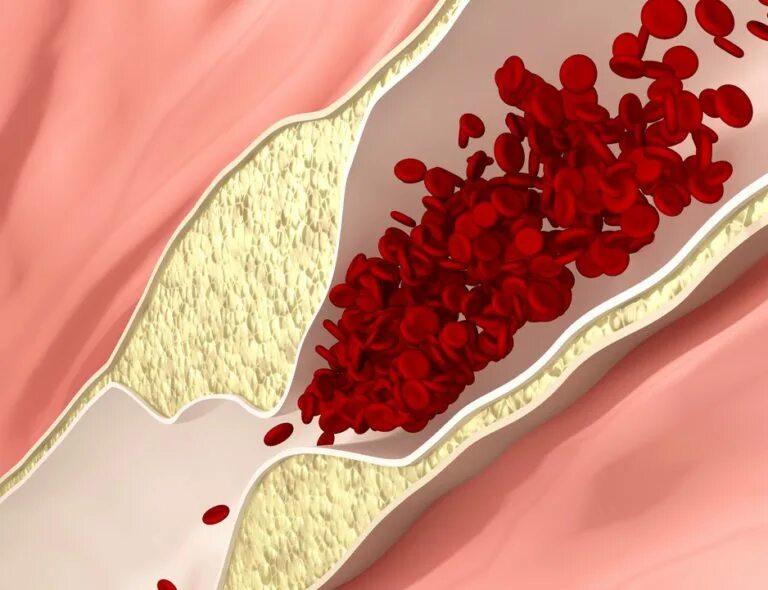 Как почистить тромбы. Чистый сосуд. Чистые кровеносные сосуды.
