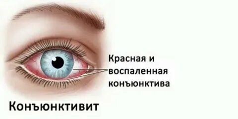 Гулять при конъюнктивите