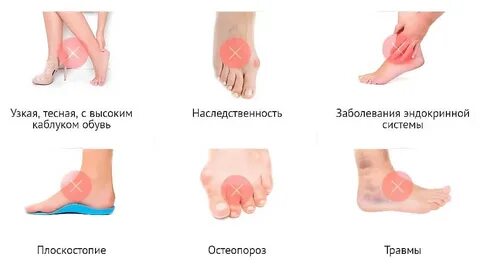 Болят подъемы ног причины