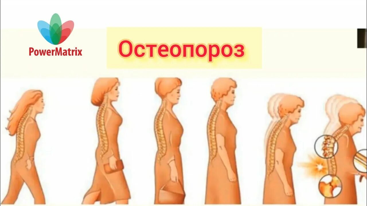 Сенильный остеопороз. Остеопороз изменения кости с возрастом. Остеопороз искривление позвоночника. Признак возрастных изменений костей