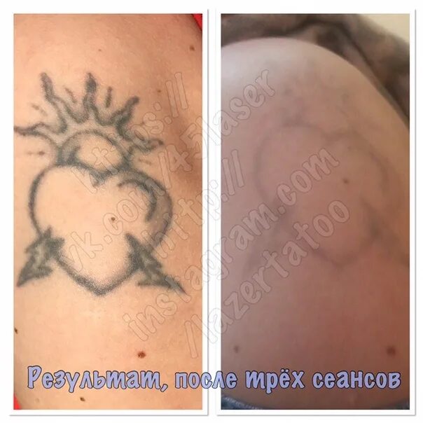 Сколько нужно сеансов для удаления тату лазером. Результат после 1 сеанса сведения татуировки лазера. тату после первого сеанса удаления лазером. 3 сеанс сведения татуировки.