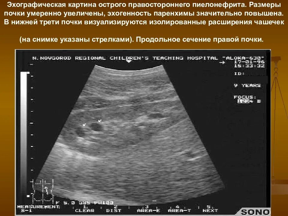 Утолщение паренхимы почек. Липоматоз поджелудочной железы на узи. истончение паренхимы почек на узи. липоматоза поджелудочной железы на узи. повышение эхогенности почек на узи.