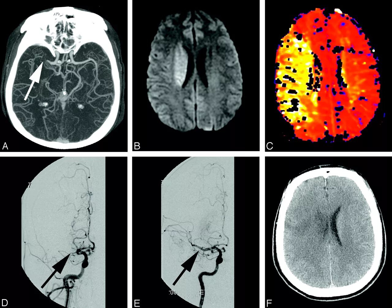 Геморрагический инсульт субарахноидальное кровоизлияние кт. Субарахноидальный инсульт кт. Субарахноидальное кровоизлияние инсульт кт. Субарахноидальное кровоизлияние головного мозга мрт. Травматическое кровоизлияние