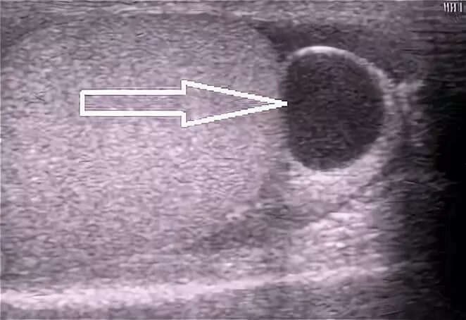 Увеличение придатка яичка. Варикозное расширение вен семенноготканатика. Уплотнение в яичке у мужчин. Орхоэпидидимит с абсцессом. Киста придатка яичка на узи.