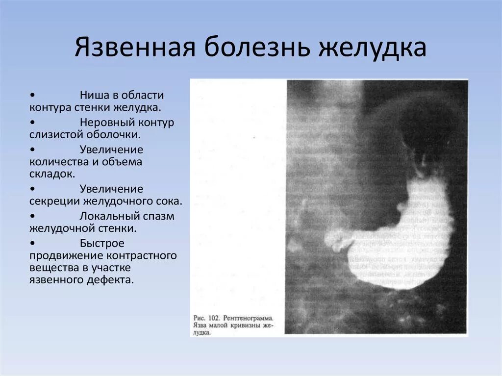 Язва кардиального отдела желудка рентген. Язвенная болезнь двенадцатиперстной кишки рентген. Язва желудка рентген ниша. Язвенная болезнь 12 перстной кишки рентген. Заключении кардии