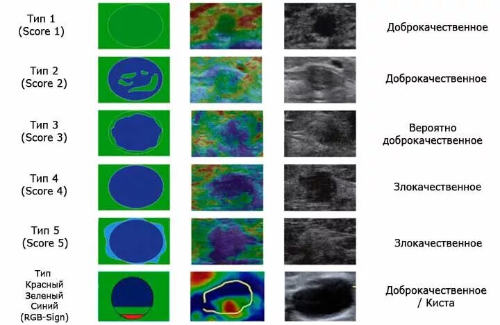 Эластография молочной железы протокол. Эластография молочных желез типы. Эластография щитовидной железы протокол. Компрессионная эластография молочных желез протокол.