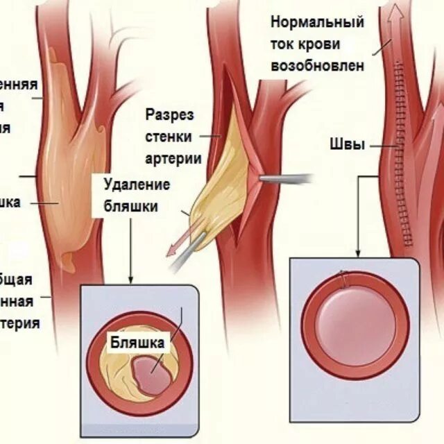 Атеросклероз вса слева. Холестериновые бляшки в сонной артерии операция. атеросклеротическая бляшка в сонной артерии. атеросклероз бляшка сонной артерии операция. атеросклероз брахиоцефальных артерий со стенозом.