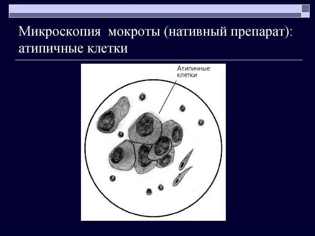 Спирали Куршмана в мокроте. Микроскопия мокроты с подписями. Состав мокроты микроскопическое исследование.