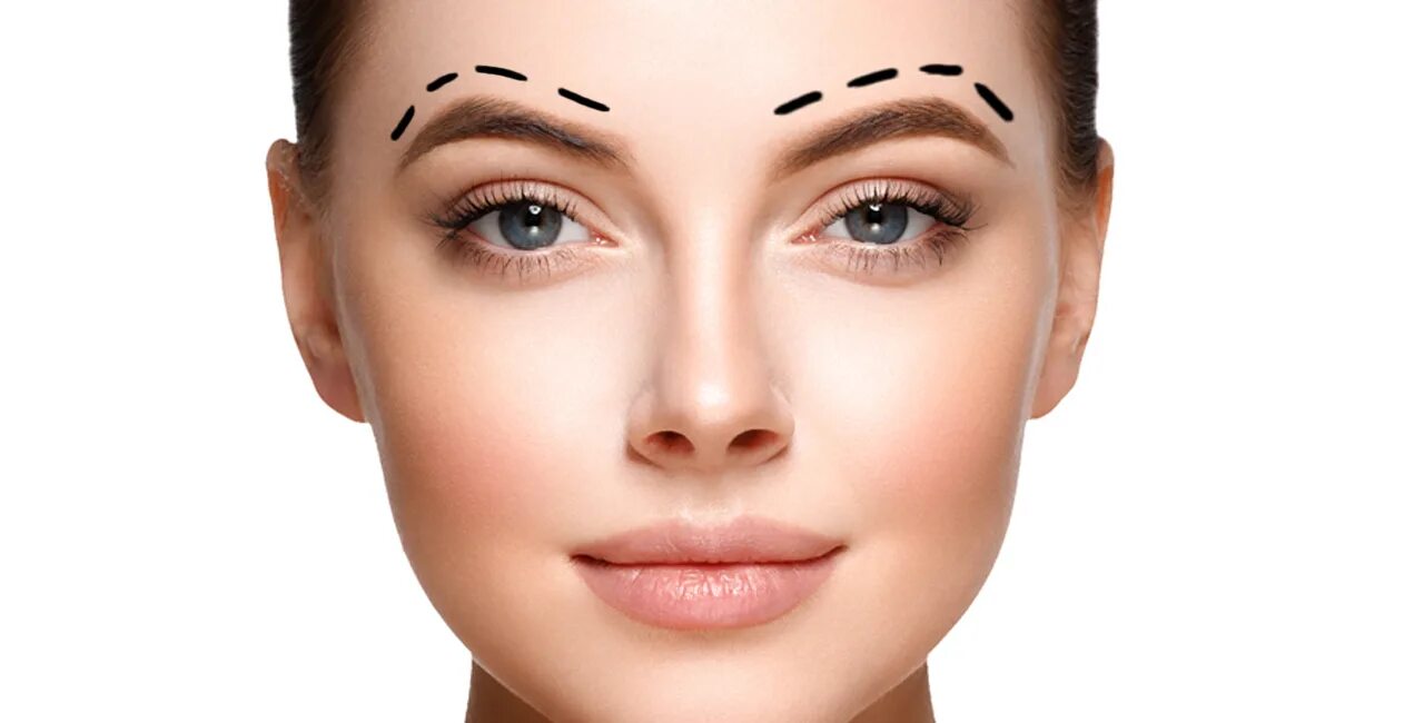 Brow lift. Асимметричные брови. Асимметрия формы бровей. Ботокс для бровей. Коррекция асимметрии бровей ботоксом.