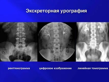 Экскреторная урография
