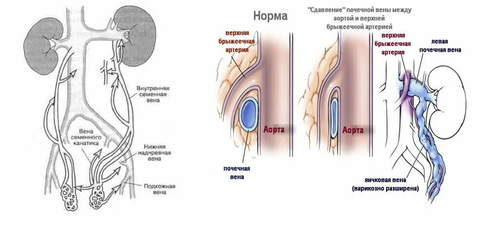 Варикозное расширение вен семенного канатика яичка.. Варикоцеле почечная Вена. Почечная Вена яичковая Вена. Варикоцеле у детей клинические рекомендации. Венозное сплетение яичка