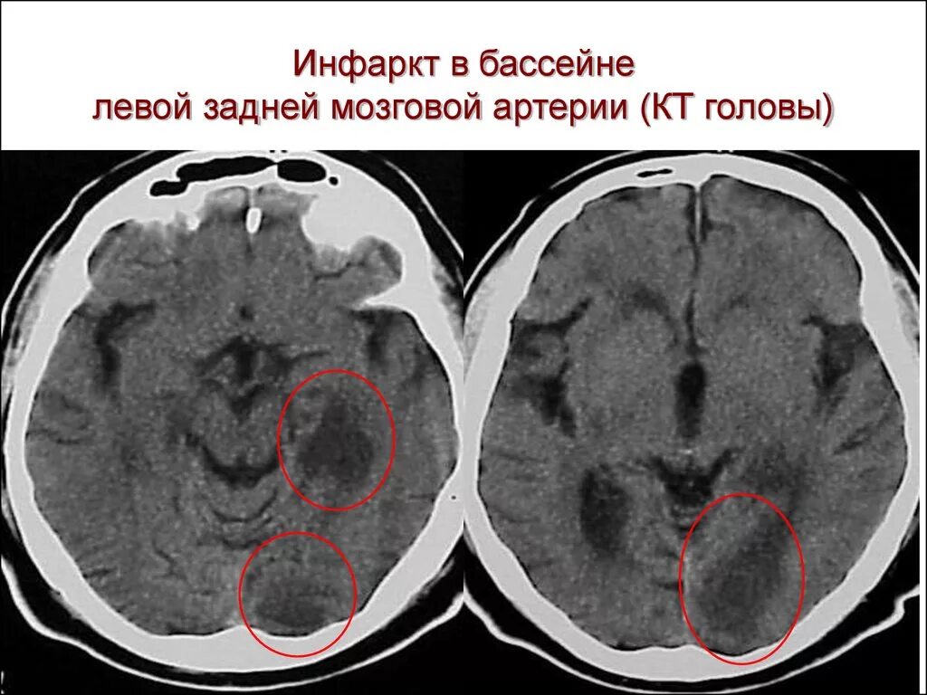 Инсульт в бассейне мозговой артерии. Кт головного мозга ОНМК. Ишемический инсульт мозга на кт. Ишемический инсульт на кт головного мозга. Ишемический инсульт левой средней мозговой артерии.