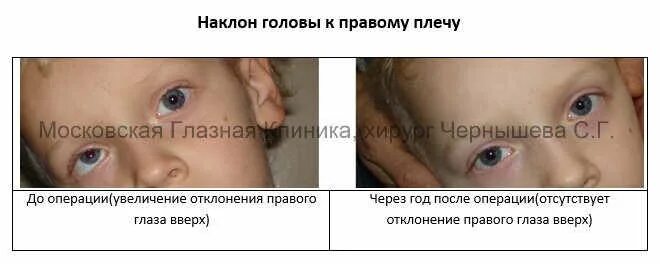 Операция по исправлению косоглазия у детей. Операция по исправлению косоглазия у детей