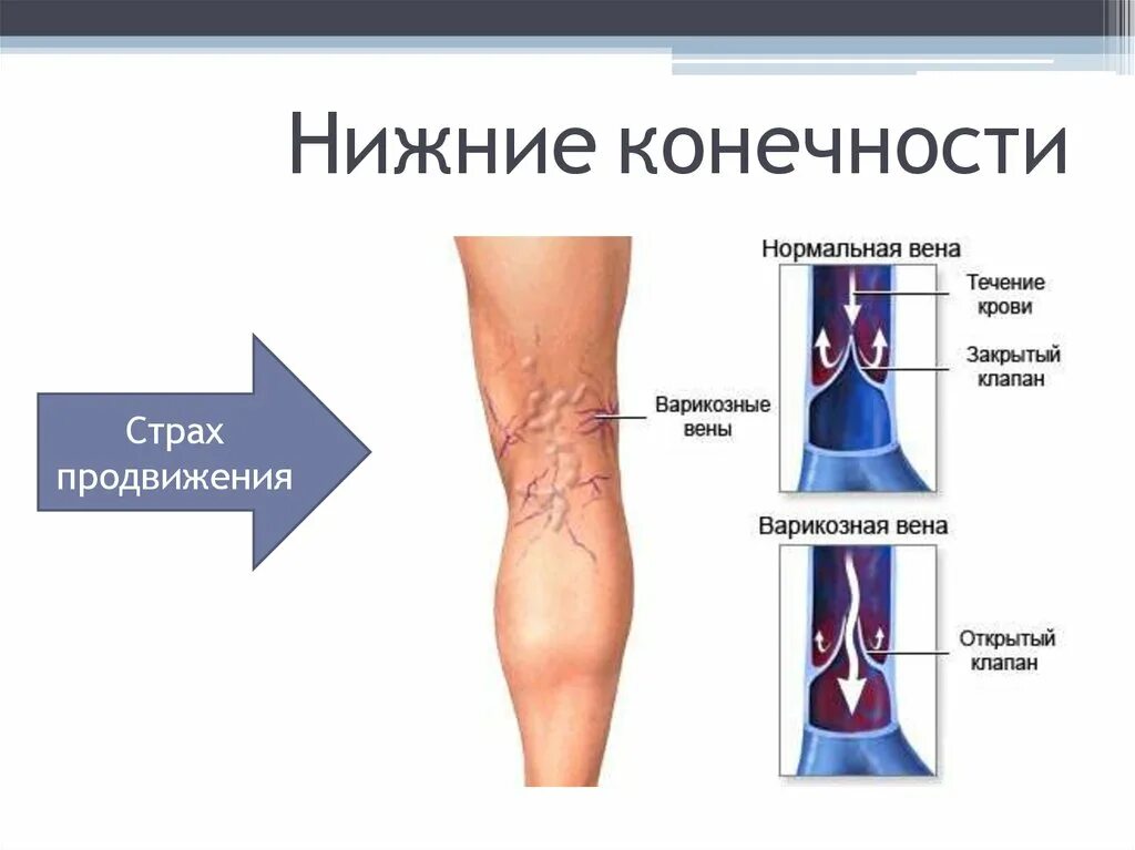 Варикозная болезнь вен нижних конечностей код