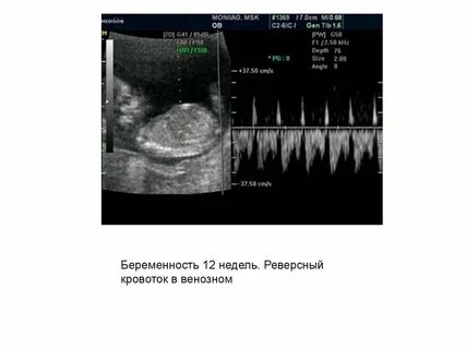 Норма венозного протока