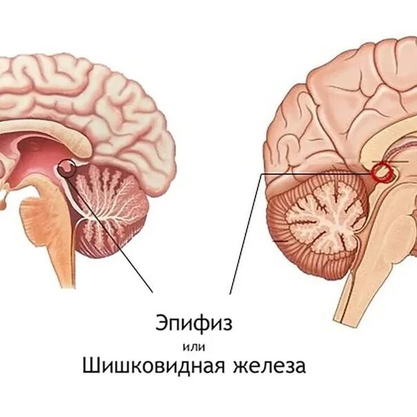 Пинеальная железа это. Шишковидное тело в головном мозге. Киста шишковидной железы. Киста шишковидного тела в головном мозге.