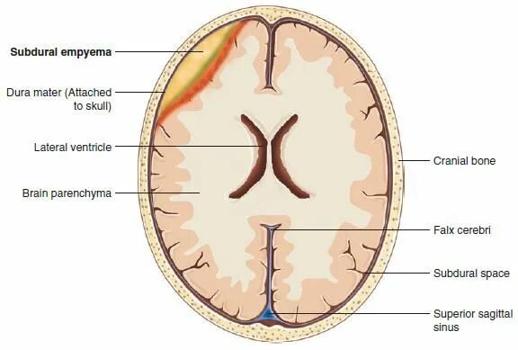 Эмпиема латынь. Субдуральная эмпиема на мрт. Эмпиема твердой мозговой оболочки.