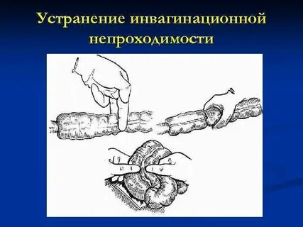 Непроходимость кишечника какая операция