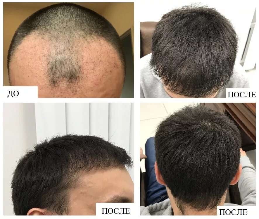 Волосы после пересадки волос. Волосы после пересадки волос. Hfe пересадка. Трансплантация волос fue. Hfe пересадка.