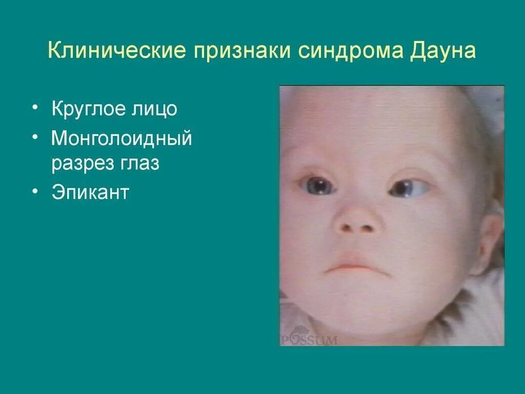 Почему у ребенка синдром дауна. Синдром дауна проявления. клинические проявления синдрома дауна. пртзнаки синдром дауна. силромы дауны симптомы.