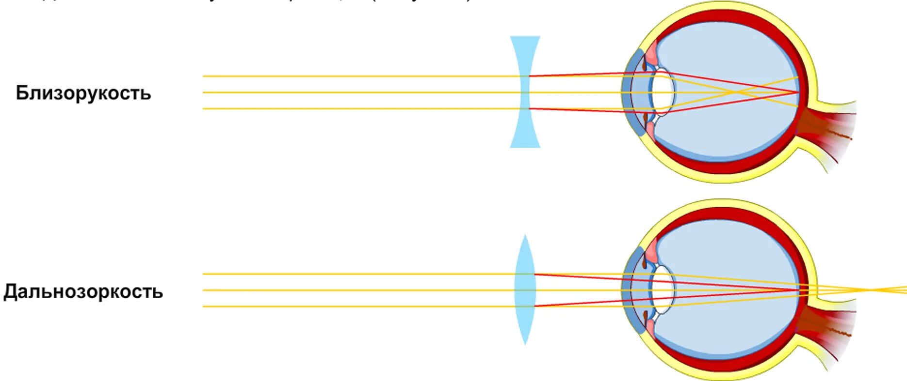 Близорукость и дальнозоркость схема физика. Линзы схема для близорукости и дальнозоркости. Линзы при дальнозоркости и близорукости физика. Миопия схема глаза. Какое зрение при дальнозоркости