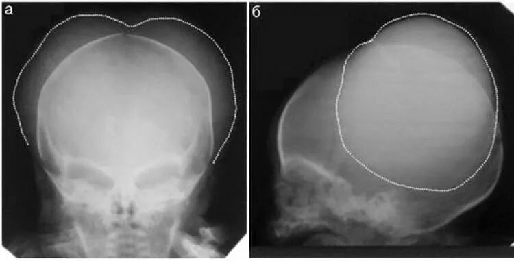 Трещина в голове. Кефалогематома рентген. Кефалогематома теменной кости. Кефалогематома теменной кости справа. Кефалогематома черепа рентген.